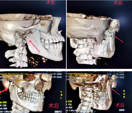 意外摔伤颌面部，以岭医院口腔科髁状突骨折内固定术助其复位